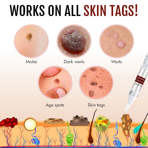 1+1 Free! - WipeOff™ Tags & Moles Remover